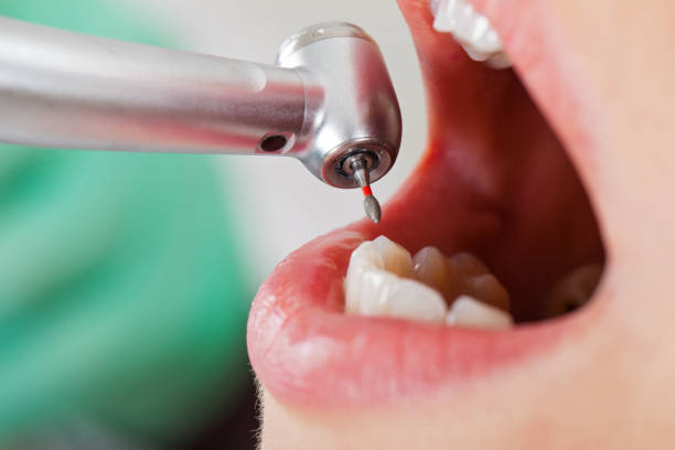 Best Emergency Tooth Extraction in Hansville, WA